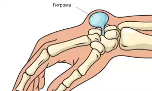 Гигрома на запястье