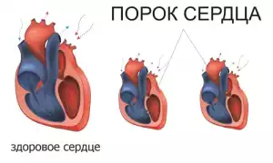 Что такое порок сердца при беременности у плода