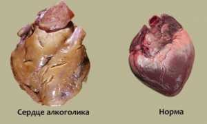 Болезнь бычье сердце