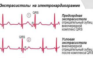 Опасны ли наджелудочковые экстрасистолы и какая их норма