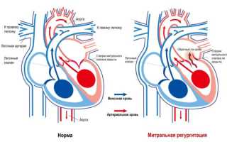 Дисфункция митрального клапана