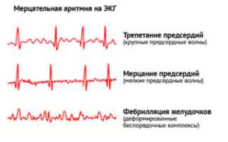 Какая бывает аритмия