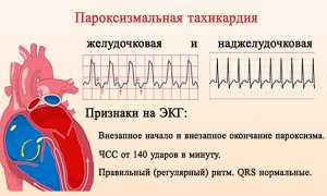 Желудочковая пароксизмальная тахикардия