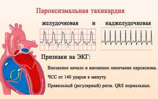 Желудочковая пароксизмальная тахикардия