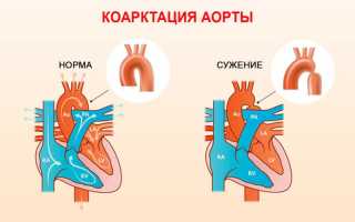Коарктация аорты у детей: причины, симптомы, диагностика и лечение
