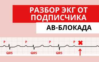 АВ блокада 2 степени