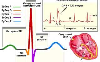 Экстрасистолия желудочковая