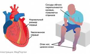 Что такое полная блокада сердца