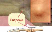 Чем опасна гигрома