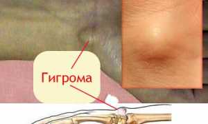 Чем опасна гигрома