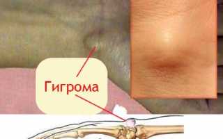 Чем опасна гигрома