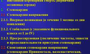 Классификация ИБС