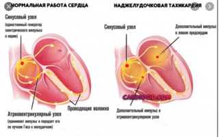 Чем отличается аритмия от тахикардии