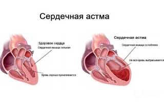 Сердечная астма: симптомы и лечение