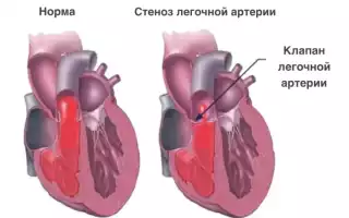 Стеноз клапана легочной артерии