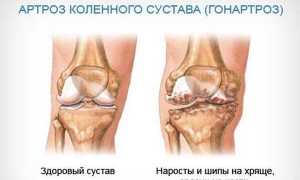 Заболевание гонартроз