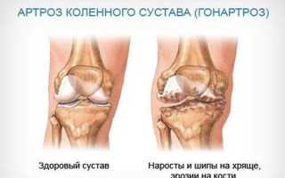 Заболевание гонартроз