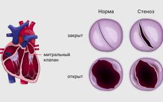Митральный стеноз