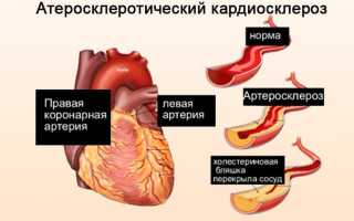 Атеросклеротический кардиосклероз