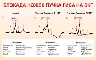 Что такое полная блокада левой ножки пучка Гиса, лечение и прогноз