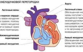 Межжелудочковой перегородки дефект