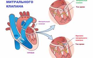 Что такое пролапс митрального клапана гемодинамически незначимый