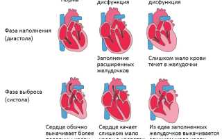 Хроническая сердечная недостаточность