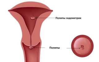 Полип эндометрия в матке: причины возникновения