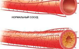 Атеросклероз сосудов головного мозга: симптомы и лечение
