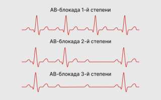 АВ блокада 1 степени на ЭКГ: что это такое