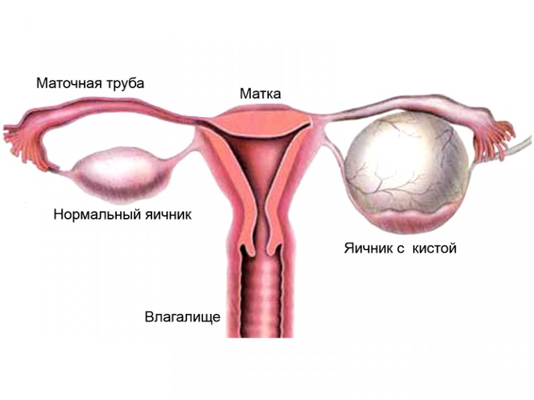 Какие существуют виды кист